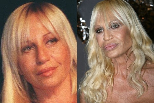 Donatella-Versace-plastic-surgery.jpg